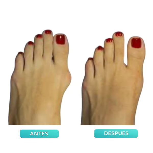 🎁 Father's Day Deal 👣Adjustable Bunion Corrector Toe Alignment Brace–  Breathable, Washable