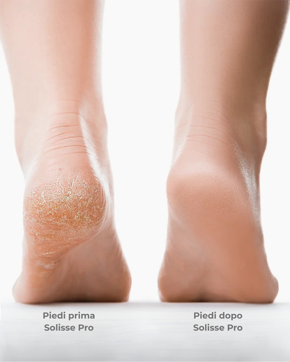 🔥HOT SALE 49% OFF 🔥 Electric Foot Callus Remover